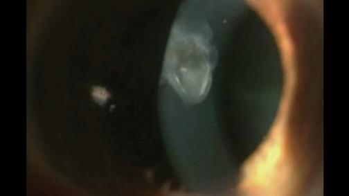 Figure 2. This patient’s eye had a dense, herpetic corneal scar, which Dr. Gulani treated with in-cornea laser corneoplastique. Later, the patient underwent a two-step cataract procedure.