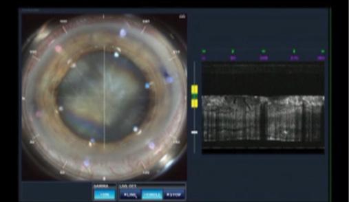 Figure 3. Dr. Gulani stabilizes the constantly moving eye of a patient who has nystagmus by applying suction the moment he can center the eye enough.
