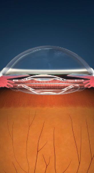 Figure 2. iolAMD is based on the concept of a Galilean telescope, with two foldable acrylic lenses, one in the capsular bag and one in the sulcus.