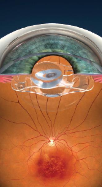 Figure 3. The asymmetric haptics of the sulcus lens result in an offset of the two lens optics.