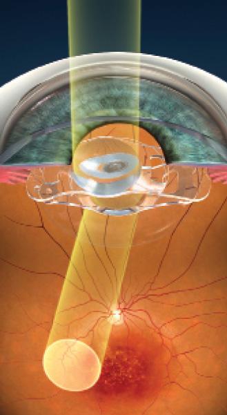Figure 4. The offset of the optics results in projection of the image onto healthy tissue, away from the damaged macula.