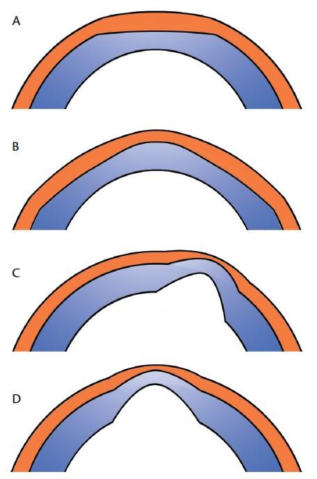 Figure 1. Schematic drawing of cross-sectional corneal images showing epithelial remodeling after myopic treatment (A), after hyperopic treatment (B), in keratoconus (C), and in corneal ectasia secondary to myopic treatment (D).