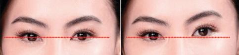 Figure 2. Schematic drawing showing a patient's head position during custom data acquisition; correct leveling, where a horizontal line intersects the pupil center of the right and left eyes (A), and incorrect leveling (B) are shown.