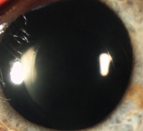 Figure 2. Postoperative outcome in an eye with a dislocated lens that underwent LACS.