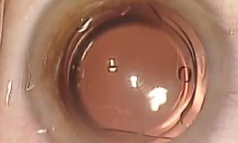 Figure 2. The Reverso lens in situ.