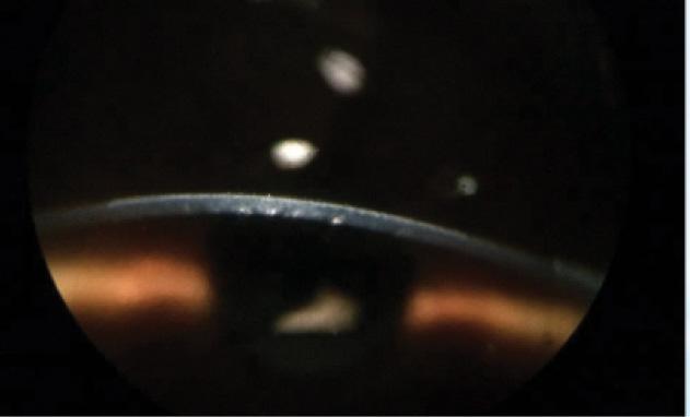Figure 3. First clinical result: myopic onlay treatment immediately after surgery with -5.00 D correction and a 6-mm optical zone.
