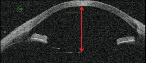 Figure 2. The use of intraoperative OCT in the oculars of a microscope.