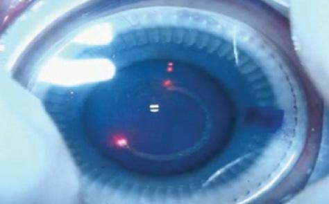 Figure 3. The CapsuLaser being used to create a capsulorrhexis.