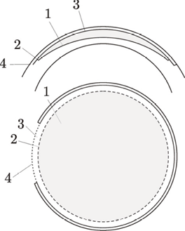 Figure 1. Cross-section
of the cleavage planes
created during SMILE:
(1) posterior lenticule
surface, (2) vertical
edge cut, (3) anterior
lenticule surface, and
(4) corneal sidecut.