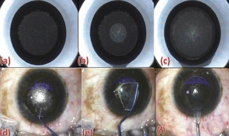 Figure 2. Surgical steps of the SMILE procedure, including
laser-assisted and manual steps. Laser-assisted: posterior
tissue disruption plane, or lenticule cut (A); anterior tissue
disruption plane, or flap cut (B); superior flap and sidecut
incision (C). Manual steps: delineation of planes (D),
dissection of planes (E), and lenticule removal (F).