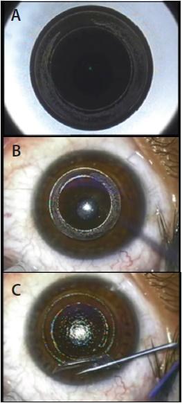 Figure 1. In Circle, a lamellar
ring is created at the same
depth as the existing SMILE
incision, allowing the
conversion of the SMILE cap
into a hinged flap. The flap is
then raised, and excimer laser
ablation is performed.