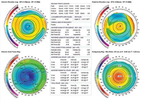 Figure 1. Scheimpflug topography/tomography (Precisio; iVis Technologies) showing (clockwise) anterior elevation, posterior elevation, axial keratometric topography, and pachymetry map in a patient with irregular astigmatism and hyper-oblate asphericity.