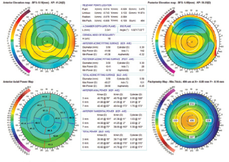 Figure 1. Precisio topography/tomography showing (clockwise) anterior elevation, posterior elevation, axial keratometric topography, and pachymetry map before repair surgery in a patient with optical asymmetry causing coma.