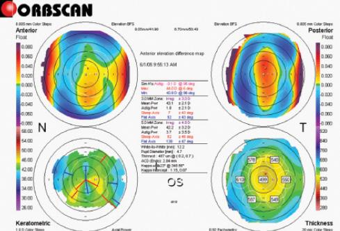 Figure 1. Orbscan topography/tomography showing (clockwise) anterior elevation, posterior elevation, axial keratometric topography, and pachymetry map before repair surgery secondary to incisional surgery in a patient with anterior and posterior protrusion along the vertical meridian.