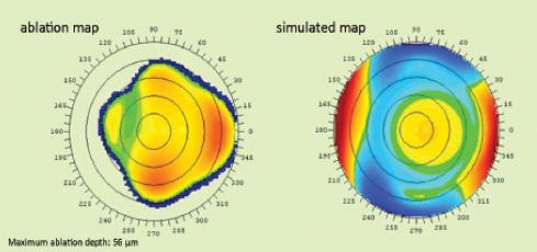 Figure 2. A topography-guided ablation map (A) and simulated postoperative anterior corneal topography (B) generated by CIPTA software.