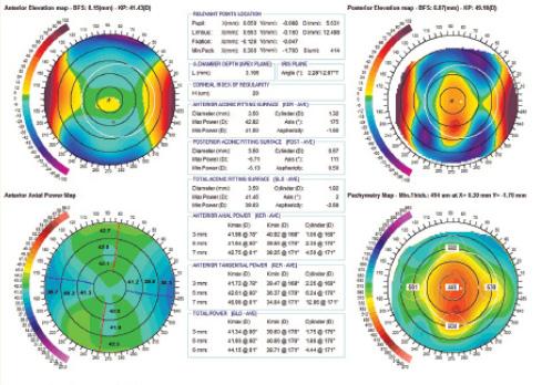 Figure 3. Precisio topography/tomography showing (clockwise) anterior elevation, posterior elevation, and pachymetry map after topography-guided ablation. Anterior elevation shows an optically regularized, symmetric profile, while posterior elevation remains irregular.