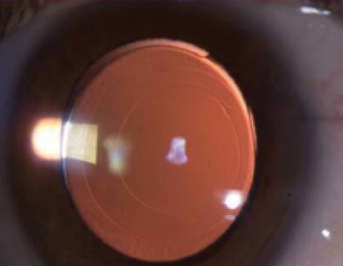 Figure 1. Anterior and posterior capsulorrhexis in a 1-year-old.