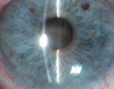 Figure 2. Supplementary IOL in a 3-year-old.
