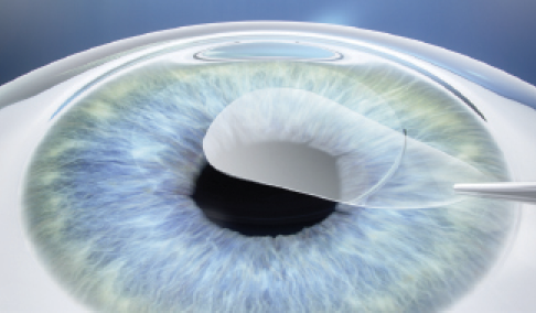 Figure 1. SMILE is a flapless and bladeless procedure based on the removal of a disc of tissue, called a lenticule, through a small incision.