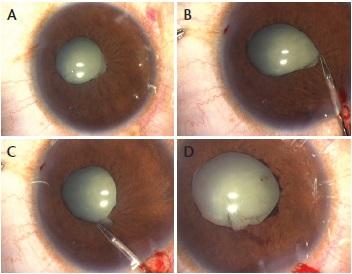 Figure 1. Eye with pupillary membranes (A); the membrane is grasped with a pair of intraocular forceps (B) and gently freed from the pupil margin (C), resulting in a significantly larger pupil (D).