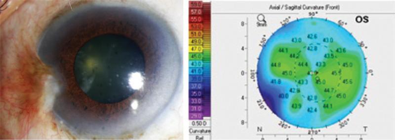 Figure 1. Case No. 1: Slit-lamp photo of regressing pterygium (A). Topography on Pentacam (Oculus Optikgeräte) shows regular astigmatism not induced by the pterygium, which is causing only peripheral changes in the topography (B). This patient can undergo cataract surgery without any prior surgical intervention for the pterygium.