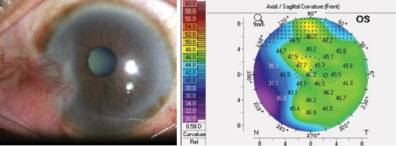Figure 2. Case No. 2: Slit-lamp photo of a large, fleshy pterygium (A). Although it is difficult to detect the extension of the pterygium into the central cornea on the slit-lamp photo, the Pentacam shows irregular astigmatism of the central cornea induced by the pterygium (B). This patient would benefit from pterygium excision before cataract surgery.