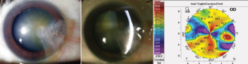 Figure 3. Case No. 3: Slit-lamp photos of an extensive pterygium covering the visual axis (A, B). Topography shows irregular mires and is not reliable (C). Topography is not required in this patient at this time, as pterygium excision is mandatory before cataract surgery.
