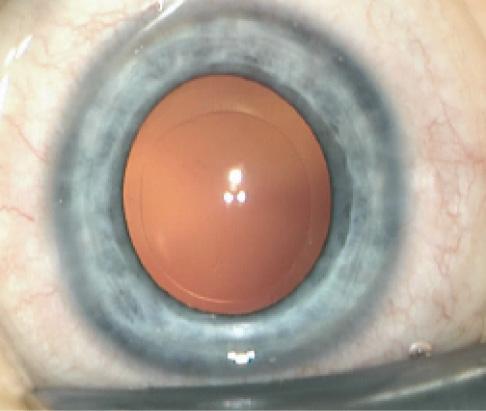 Figure 2. A perfectly sized circular anterior laser capsulotomy.