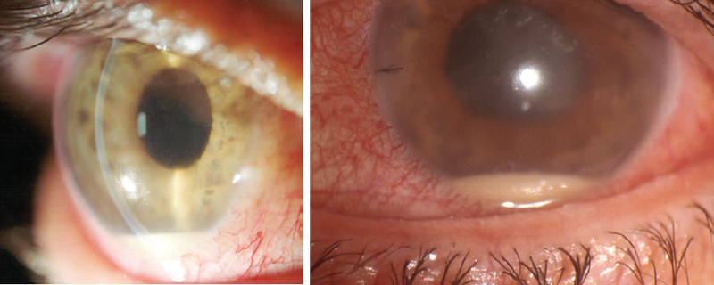 Figure 1. Postoperative endophthalmitis.