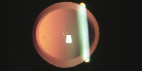 Figure 2. The KS-Aquaport is designed to restore more natural aqueous flow and eliminate the need for an iridotomy.