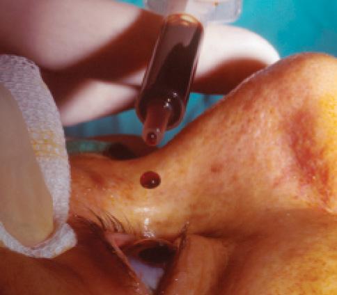 Figure 2. Topical povidone-iodine application.