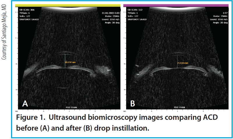 Figure 1. Ultrasound biomicroscopy images comparing ACD before (A) and after (B) drop instillation.