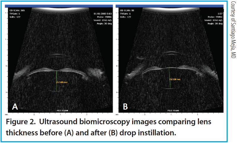 Figure 2. Ultrasound biomicroscopy images comparing lens thickness before (A) and after (B) drop instillation.