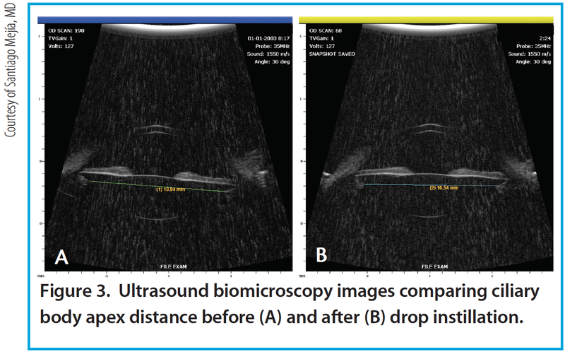 Figure 3. Ultrasound biomicroscopy images comparing ciliary body apex distance before (A) and after (B) drop instillation.