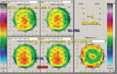 Figure 2. Topographic maps of a patient treated with CXL and topography-guided PRK.