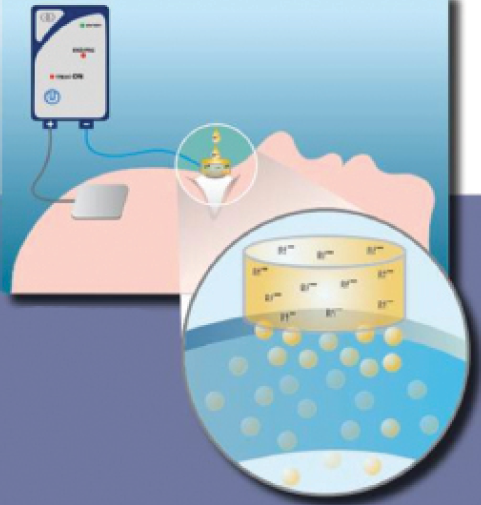 Figure 2. The drug is applied with an electrode carrying the same charge, and the ground electrode, which carries the opposite charge, is placed elsewhere on the body to complete the circuit. The generator is set at a power of 1 mA, which is applied for 5 minutes. During this phase, ion transport is performed by continuous erogation.