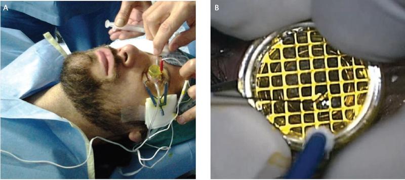 Figure 3. The connection cable and a return electrode are applied to the patient’s forehead and activated by the corneal applicator, which contains negative electrodes and adheres with a weak suction vacuum system. After verifying that the applicator is secured to the cornea by the suction, the operator covers the steel grid with riboflavin (A). After suction is completed, the grid is fully filled with riboflavin (B).