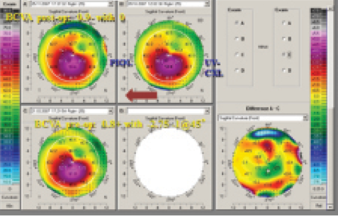 Figure 3. Topographic maps of a patient treated with CXL and phakic IOL implantation.