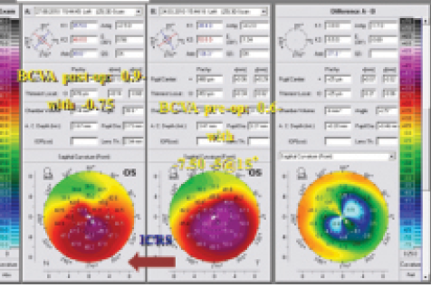 Figure 4. Topographic maps of a patient treated with CXL and ICRS implantation.