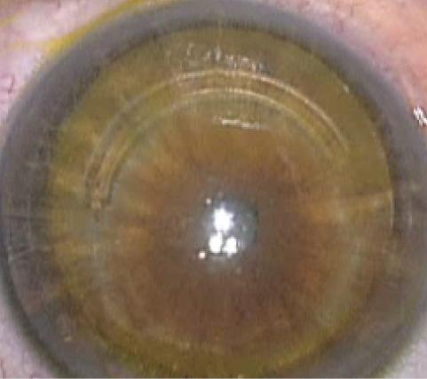 Figure 4. Visible riboflavin imbibition seen after iontophoresis and just before UV-A irradiation in a keratoconic patient with an ICRS.