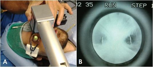 Figure 5. Riboflavin fluorescence obtained after iontophoresis and during iontophoresis-assisted CXL irradiation in a post-RK patient (A) with ectasia of the arcuate areas between the RK incisions (B).