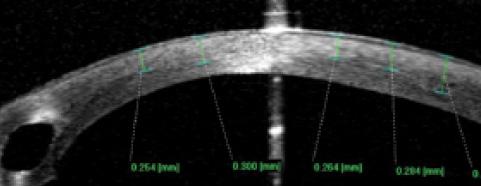 Figure 6. A gradient-type demarcation line visible on anterior segment OCT at 3 weeks after iontophoresis-assisted CXL in a patient with an ICRS. The hyperreflectivity is visible at an average of 280 μm (±220–320 μm standard deviation).
