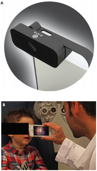 Figure 1. The D-Eye lens connected to a smartphone (A). D-Eye is used to image a pediatric patient (B).