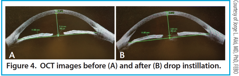 Figure 4. OCT images before (A) and after (B) drop instillation.
