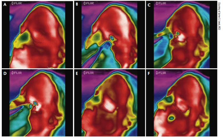 Figure 7. Thermal depiction of MiBo Thermoflo on an infrared camera with pseudo-color encoding: before treatment (A). The red skin temperature is warmer than the green nasal passages (B). MiBo heats the upper and lower lid skin to a hot white color (C). The entire meibomian gland apparatus is elevated to 108oF (D). After removal of MiBo’s emissive heat, the lid remains warm (E). More than 1 minute later, a therapeutic effect is seen (F).
