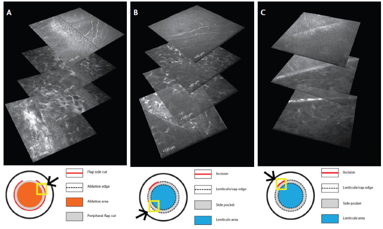 Figure 2. Sidecut IVCM stack reconstruction: In femto-LASIK, all fibers are resected throughout the extension (approximately 300°) of the flap sidecut (top panel shows resected fibers at the flap border 1 week after surgery; underlying panels show deeper stromal layers; A). In SMILE, untouched superficial fibers are observed (top panel) running over the lenticule stromal edge (bottom panel; B) The small incision represents a zone of superficial nerve fiber resection in the SMILE technique (top panel; C).