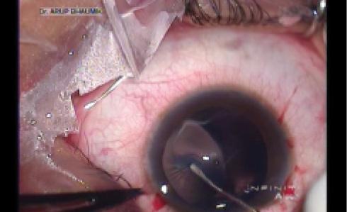 Figure 1. Puncture of an elastic anterior capsule with a longtipped cystotome.