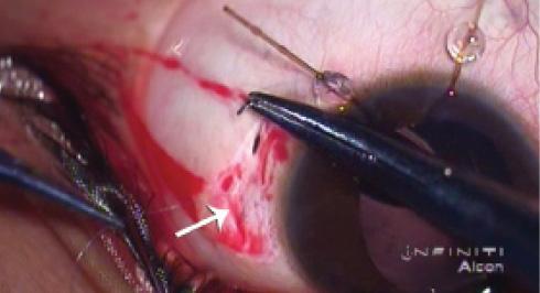 Figure 10. A Cionni ring or Ahmed CTS can be fixed to the sclera by taking multiple suture bites without a flap or knot.