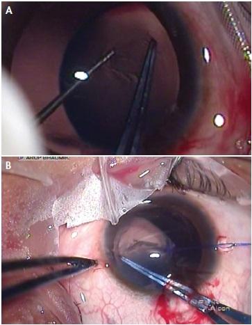 Figure 2. Countertraction with a Kuglen hook during capsulorrhexis creation (A) and countertraction with an iris hook and centration of a subluxated lens (B).