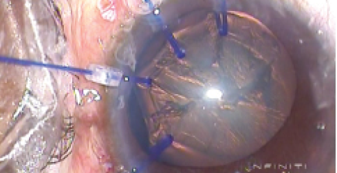 Figure 3. Capsular bag stabilization using multiple capsular hooks.